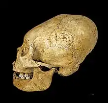 Proto Nazca deformed skull, c. 200–100&nbsp;BCE